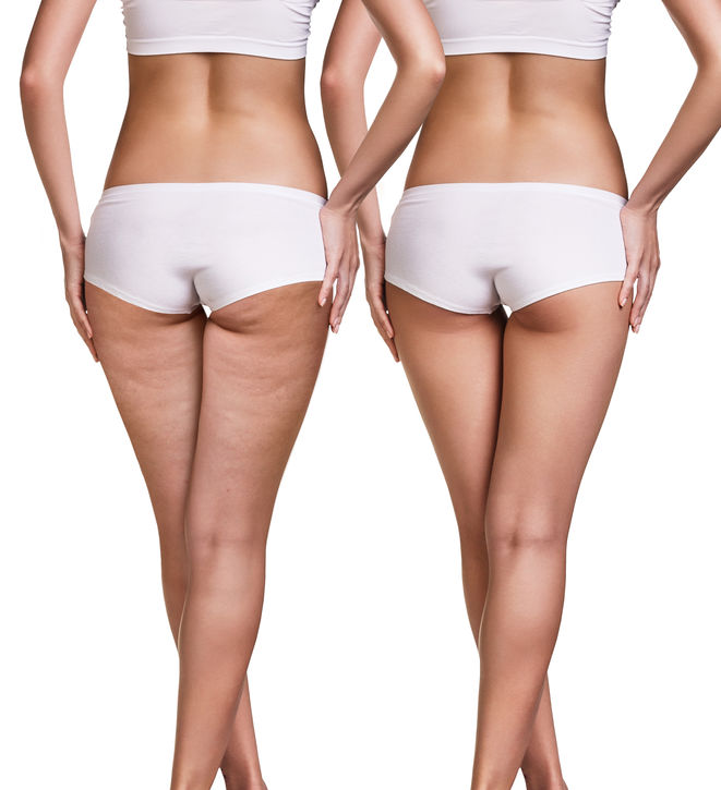 The Ultimate Guide To The Cellulite Myth - The Washington Post thumbnail