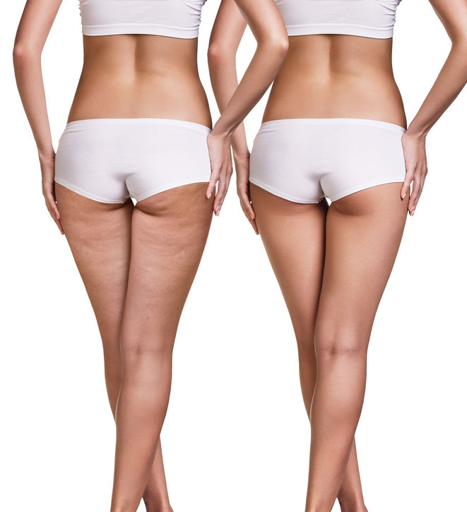 What Is Cellulite, and How We Can Remove It for Good? - Mind Body